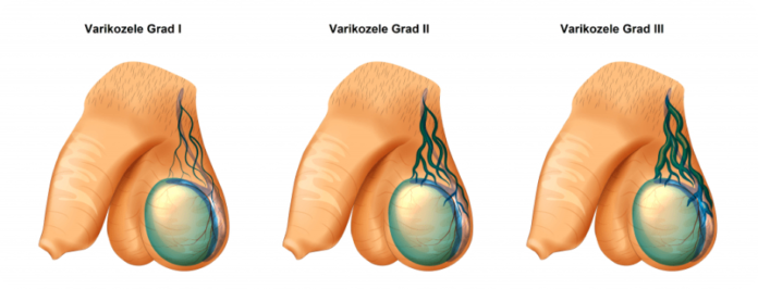 Varikozele Grad 1 - 3