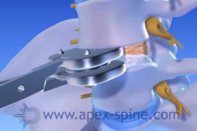 apex spine bandscheibenprothese 1
