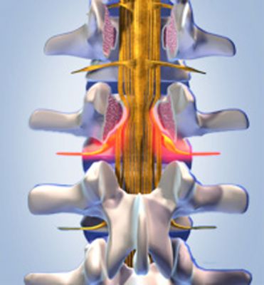 apex spine spinalkanalstenose