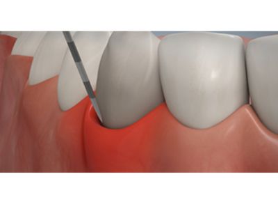 dhom parodontose