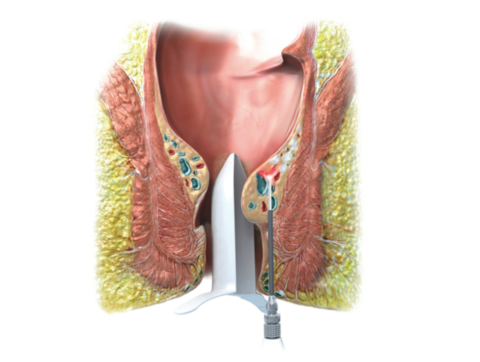 Das beste Mittel bei Hämorrhoiden? Eine vertrauensvolle Arzt-Patienten-Beziehung und die LHP-Lasertherapie!